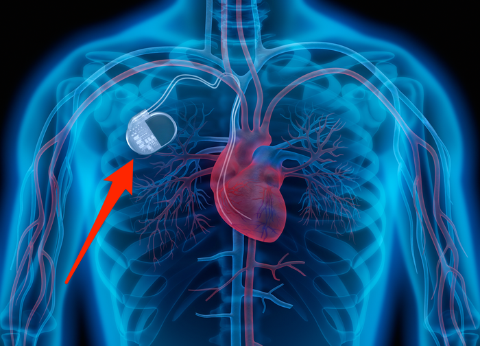 Common Questions About Pacemakers