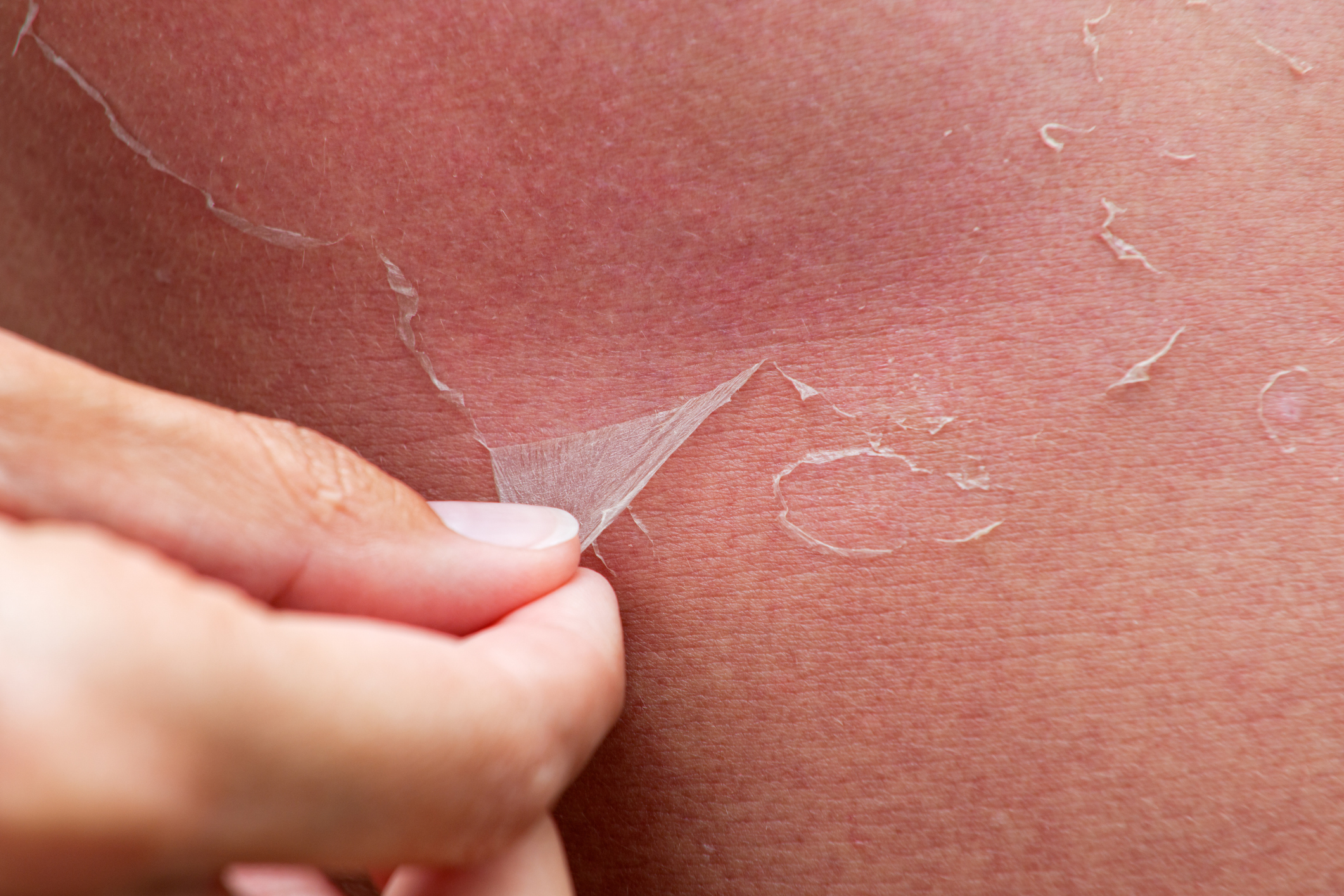 Common Treatments for Skin Cancer