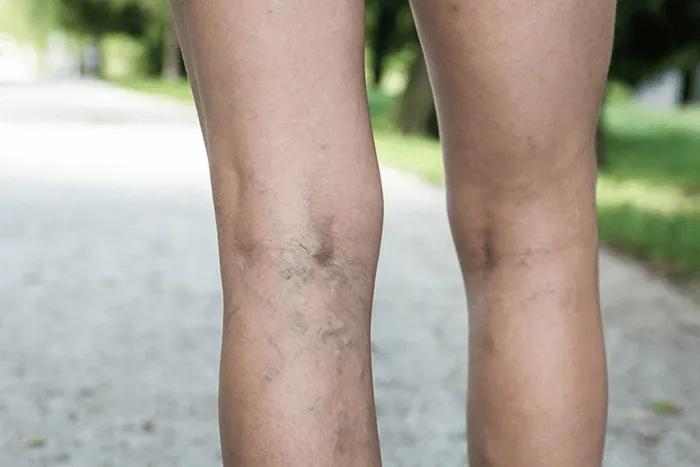 Comparing Treatments for Varicose Veins