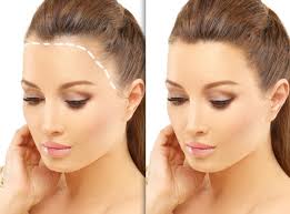 Hair Transplant Options for Women