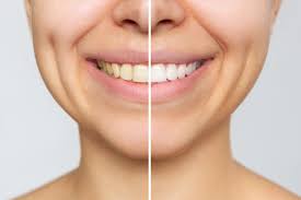Teeth Whitening for Sensitive Teeth