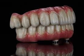 The Advantages of All-On-4 Over Traditional Dentures