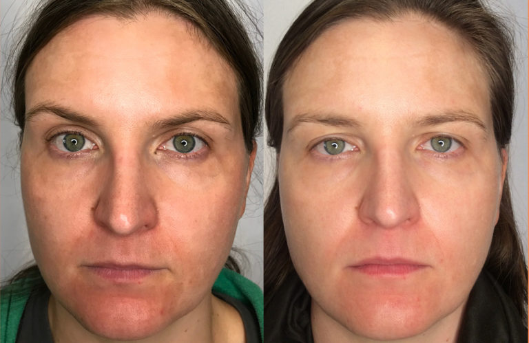 The Advantages of Laser Genesis for Non-invasive Skin Care
