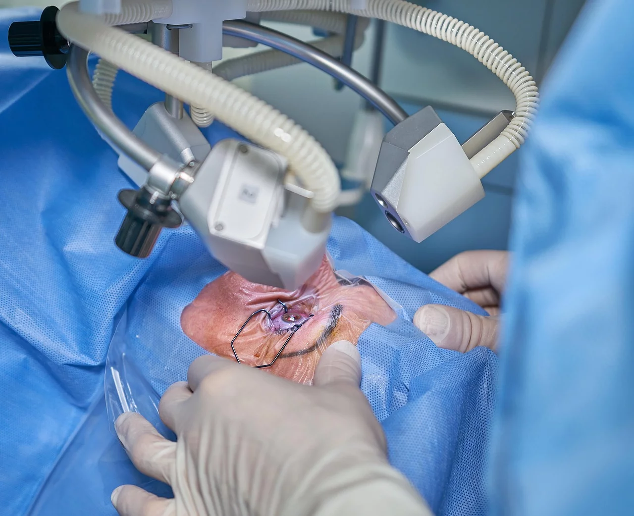 The Future of Laser Cataract Surgery