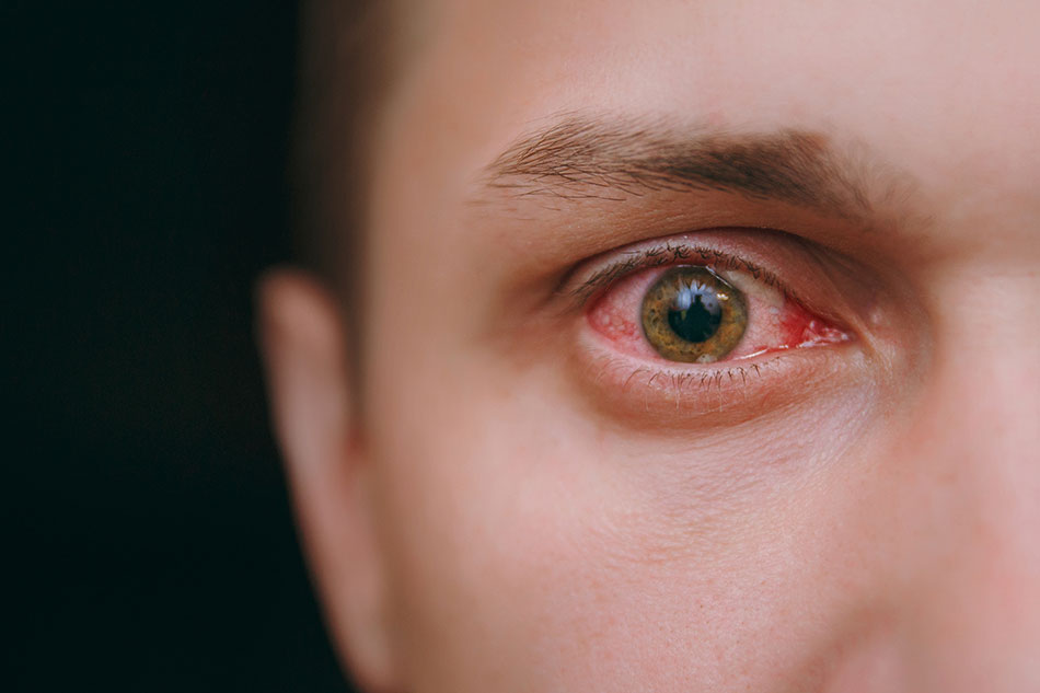 The Impact of Screen Time on Red Eye Conditions