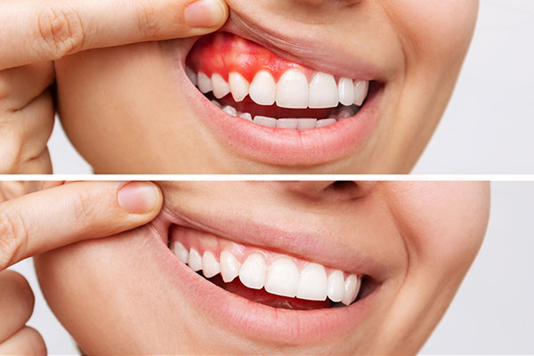 The Long-term Benefits of Regular Periodontal Treatments