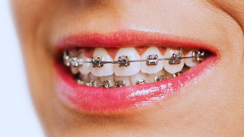The Process of Getting Braces and What to Expect During Your Treatment