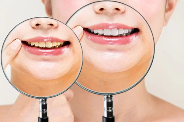The Role of Custom Teeth Whitening for Individual Needs