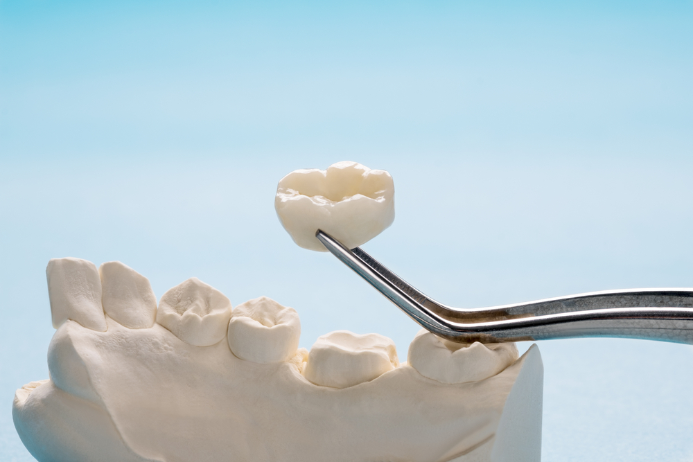 The Role of Dental Crowns in Restorative Dentistry