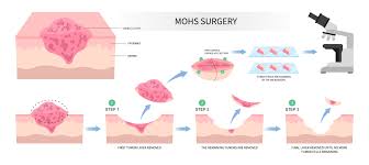 The Role of Mohs Surgery in Treating Melanoma