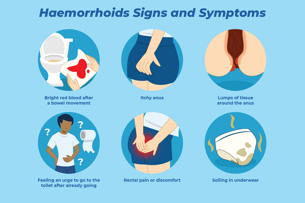 Understanding Causes and Symptoms of Hemorrhoids
