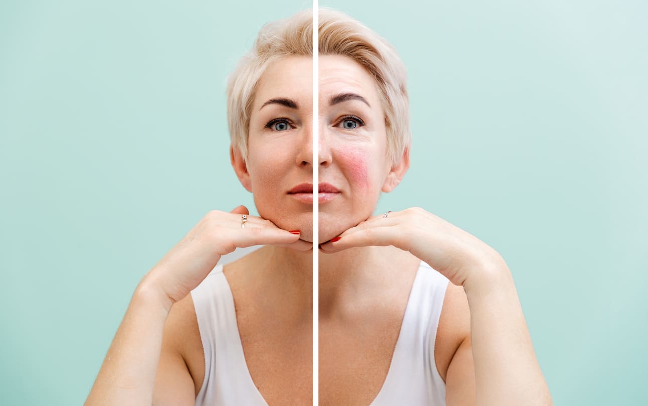 Understanding Rosacea Triggers and How To Manage Them
