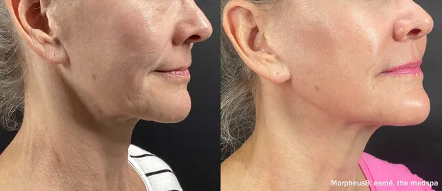 Understanding What Sets Morpheus8 Apart in Skin Care