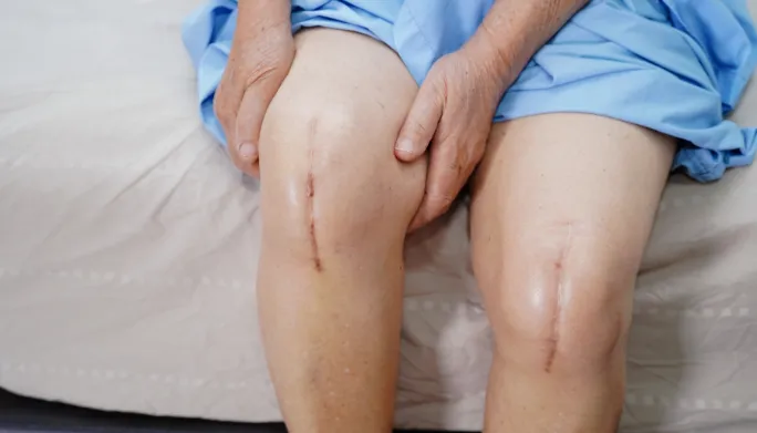 Understanding What to Expect After a Knee Replacement Surgery