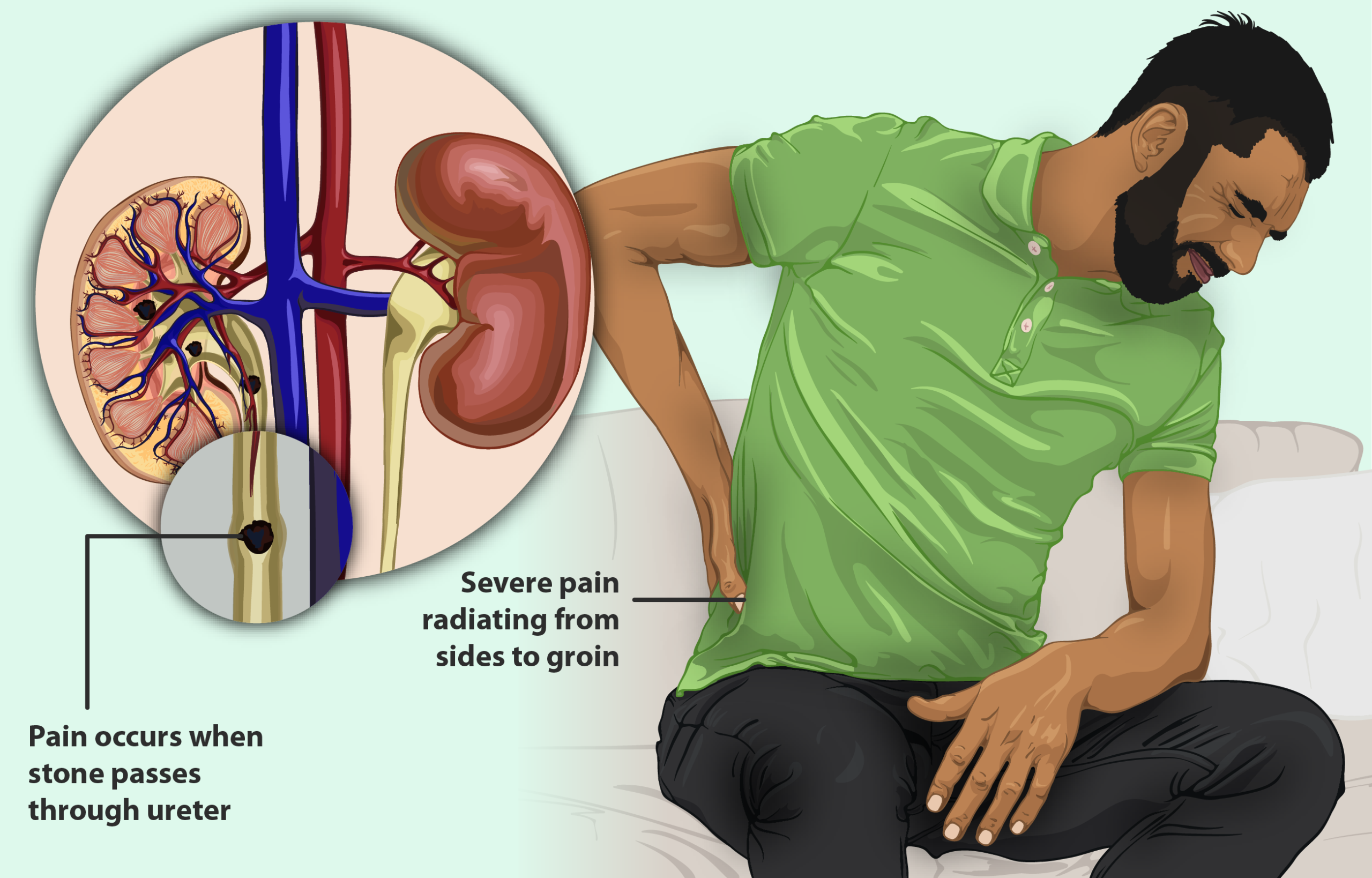 Understanding the Causes and Symptoms of Kidney Stones