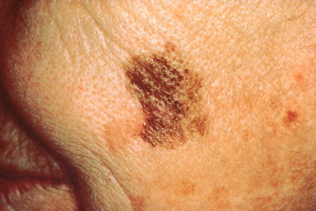 Understanding the Different Stages of Melanoma