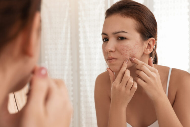 Understanding the Different Types of Acne and Their Treatments