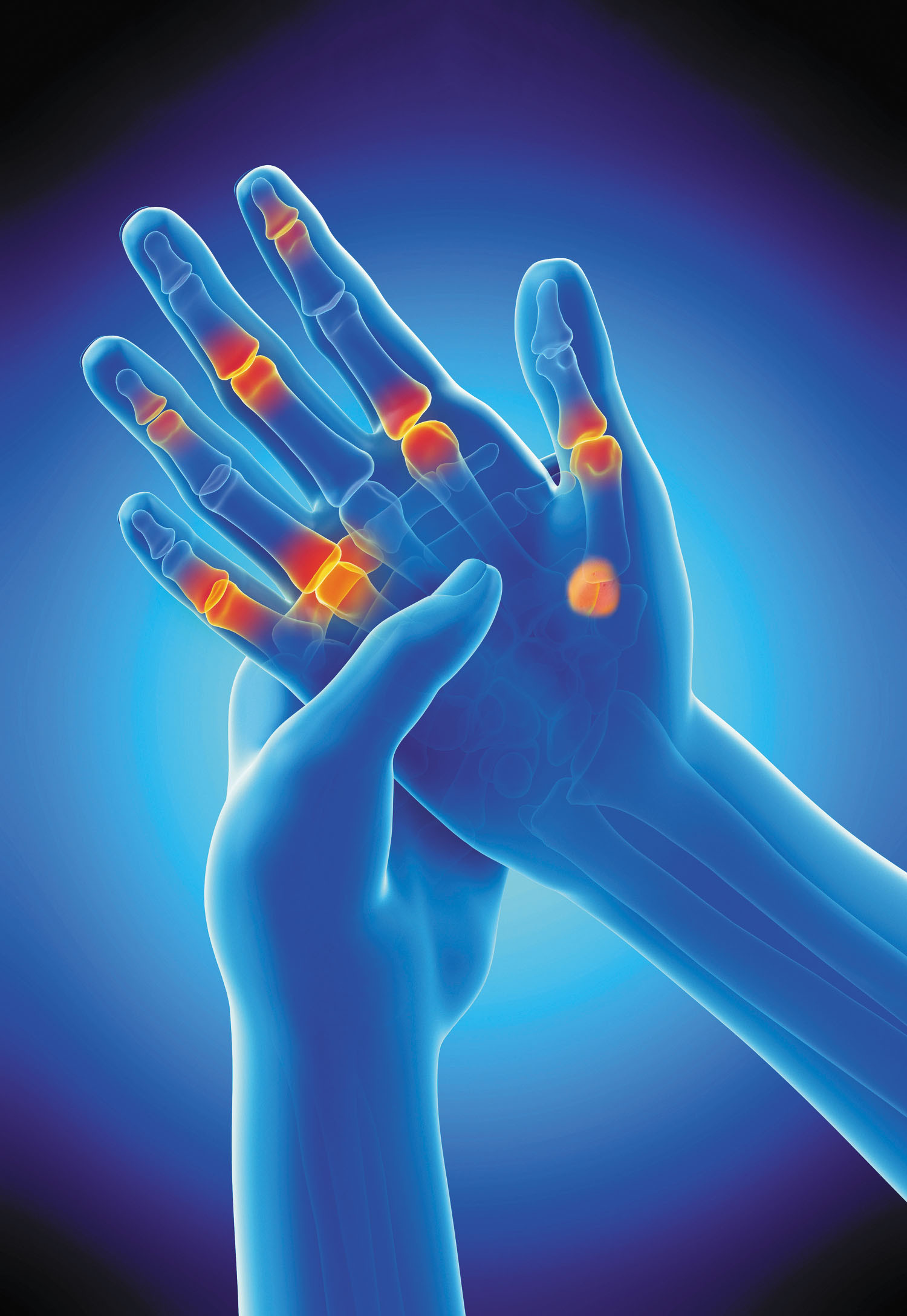 Understanding the Different Types of Arthritis
