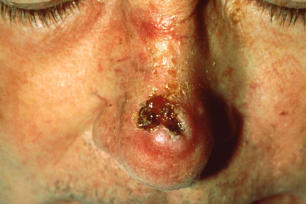 Understanding the Facts and Treatment Options About Squamous Cell Carcinoma