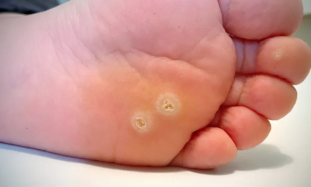 Understanding the Impact of Warts on Your Daily Life
