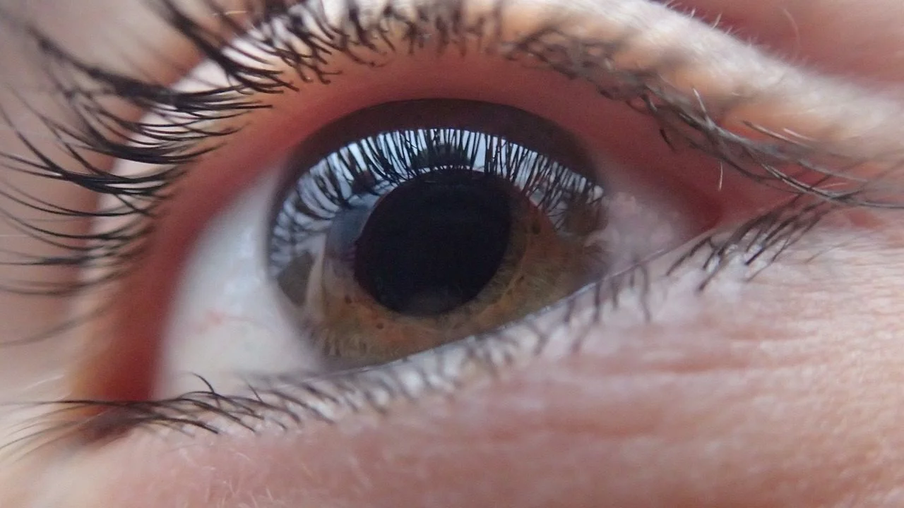 What Is Glaucoma?
