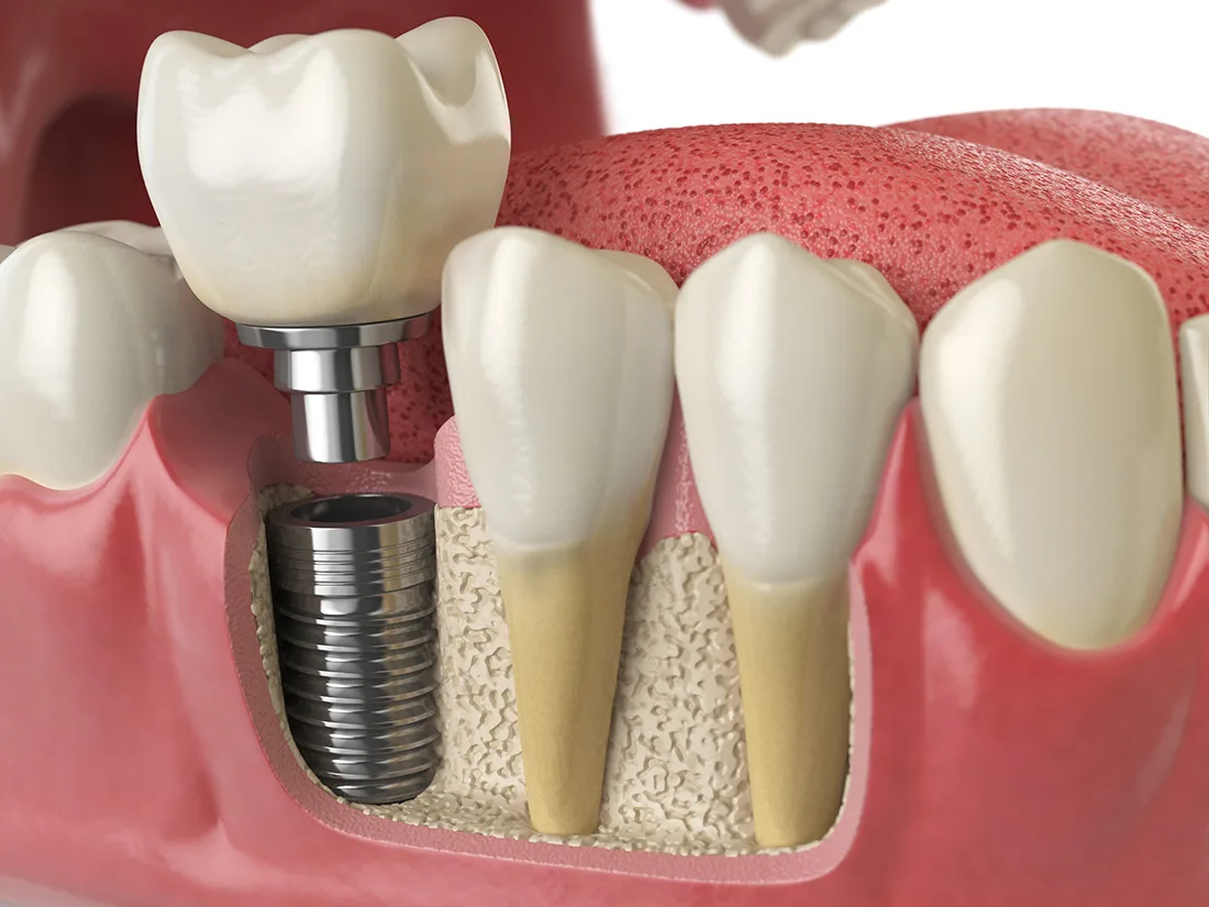 What are Dental Implants Used for?