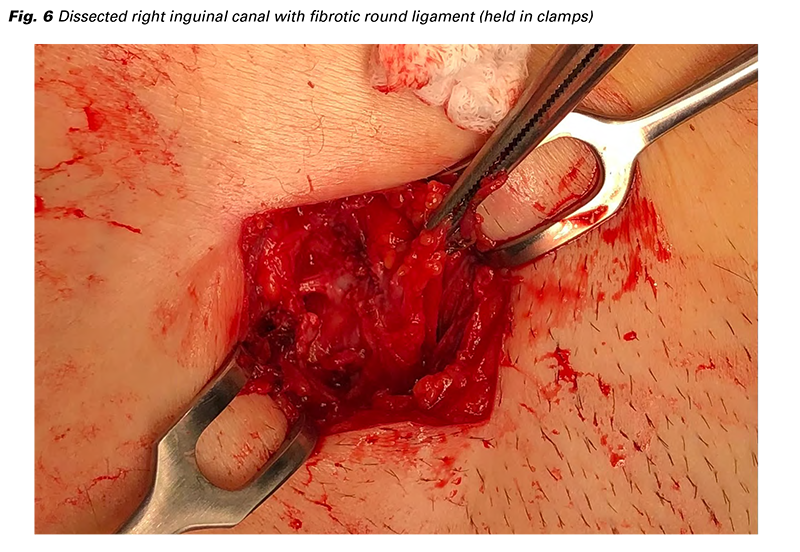 When To Seek Medical Attention for Hernias