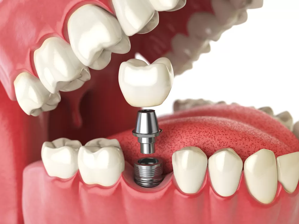 Benefits of Timely Tooth Replacement After Loss