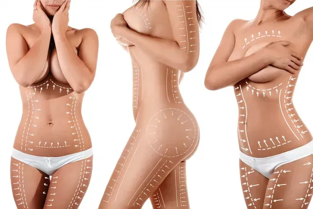 Common Areas Treated With Liposuction