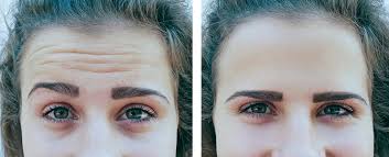 Common Questions About Botox Safety and Efficacy