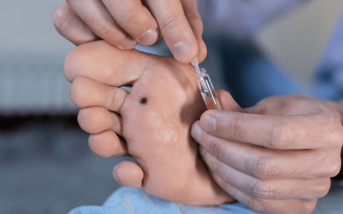 Effective Treatments for Common Warts