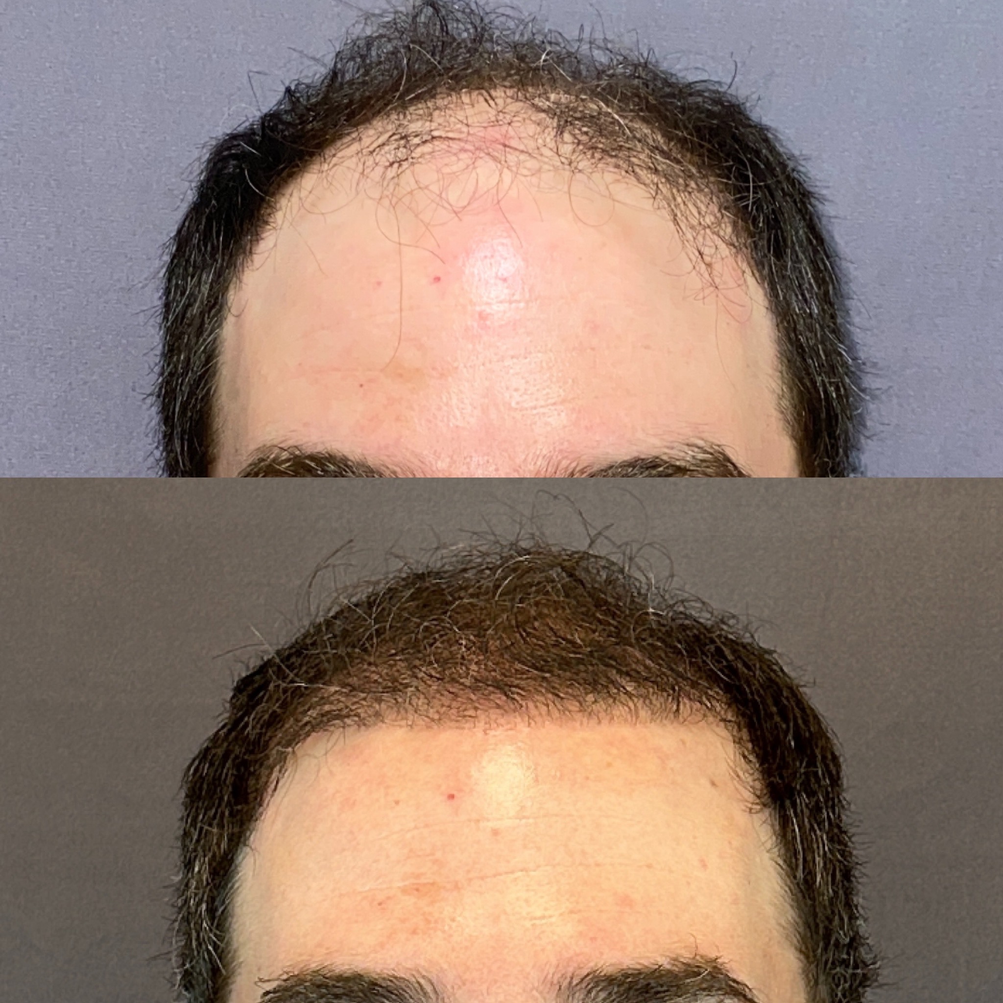 FUE Hair Transplant for Dealing With Hair Loss
