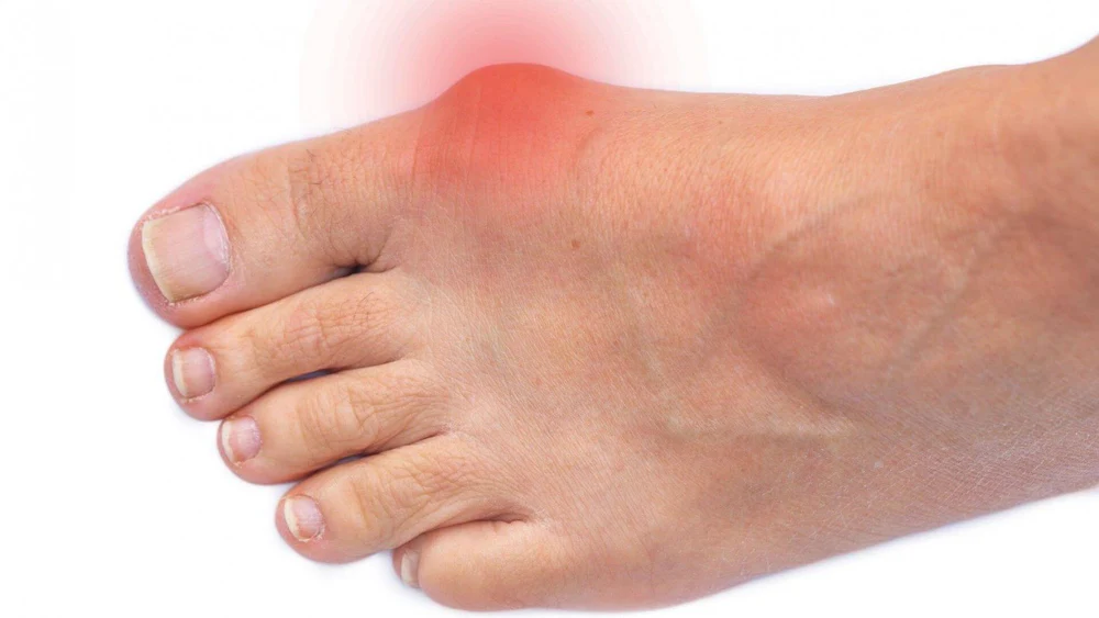 Foot Care Tips for Those with Bunions