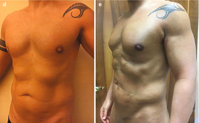 How Fat Grafting Enhances Your Body Contouring Results