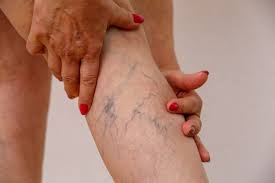 Preventative Measures for Managing Varicose Veins