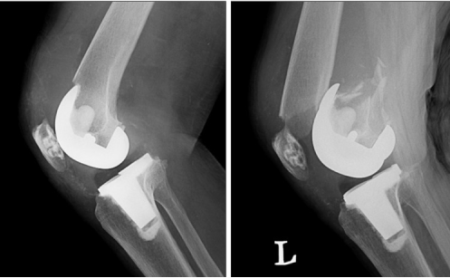 The Long-Term Benefits of Joint Replacement Surgery