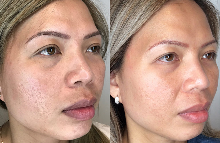The Role of Microneedling in Skin Rejuvenation