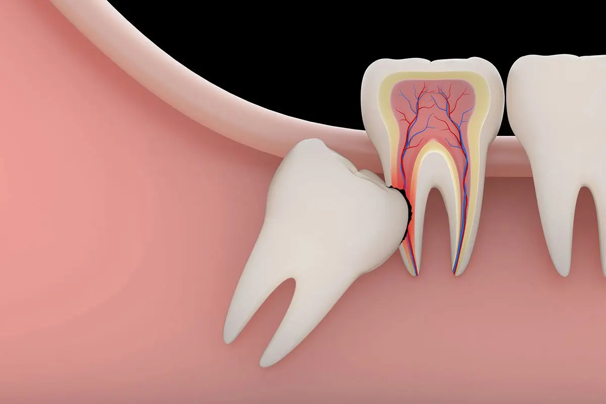 What Happens If You Don’t Remove Your Wisdom Teeth?
