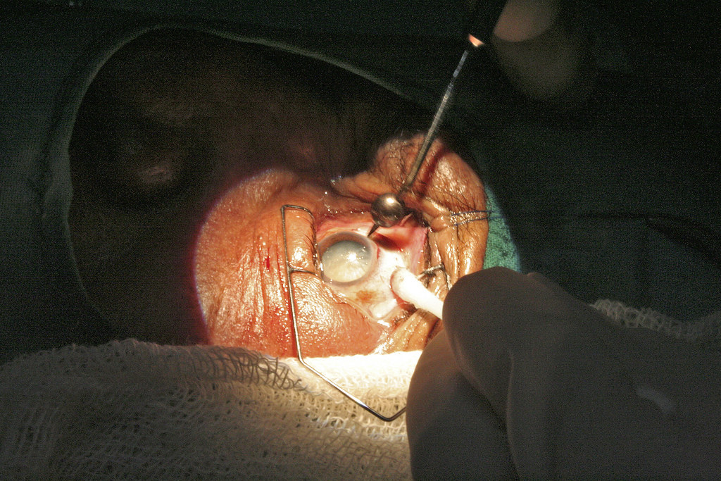 What You Need To Know for a Successful Cataract Surgery Procedure