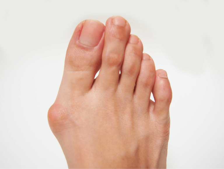What You Need to Know About Bunion Causes and Treatment