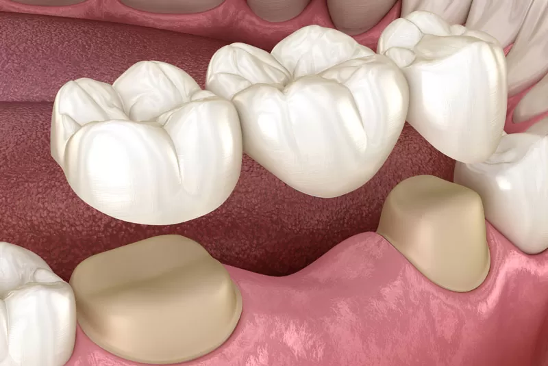 When To Get a Dental Bridge